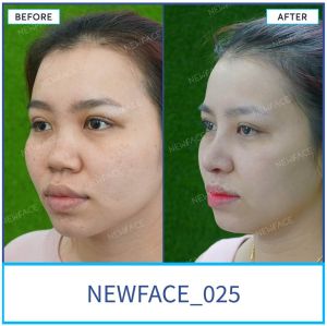 Hình ảnh nâng mũi trước sau Bs Trần Phương - Ca 25