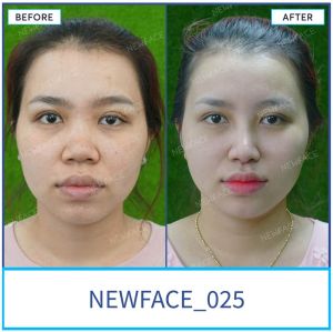 Hình ảnh nâng mũi trước sau Bs Trần Phương - Ca 25