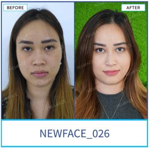 Hình ảnh nâng mũi trước sau Bs Trần Phương - Ca 26