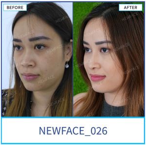 Hình ảnh nâng mũi trước sau Bs Trần Phương - Ca 26