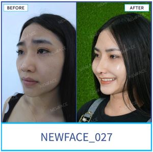 Hình ảnh nâng mũi trước sau Bs Trần Phương - Ca 27