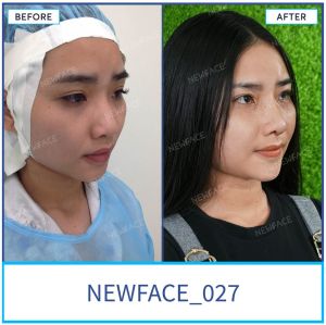 Hình ảnh nâng mũi trước sau Bs Trần Phương - Ca 27