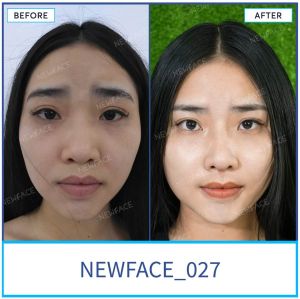 Hình ảnh nâng mũi trước sau Bs Trần Phương - Ca 27