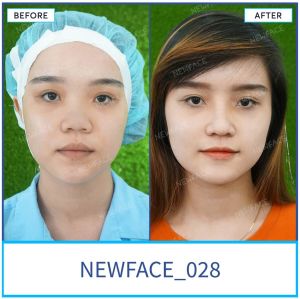Hình ảnh nâng mũi trước sau Bs Trần Phương - Ca 28