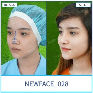 Hình ảnh nâng mũi trước sau Bs Trần Phương - Ca 28