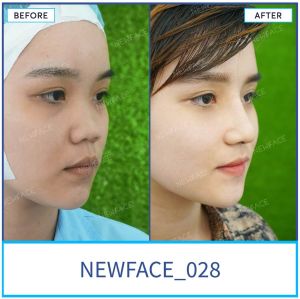 Hình ảnh nâng mũi trước sau Bs Trần Phương - Ca 28