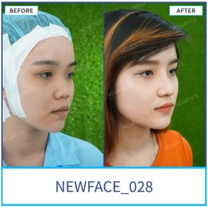 Hình ảnh nâng mũi trước sau Bs Trần Phương - Ca 28
