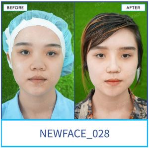 Hình ảnh nâng mũi trước sau Bs Trần Phương - Ca 28