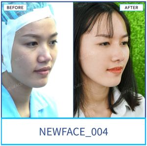 Hình ảnh nâng mũi trước sau Bs Trần Phương - Ca 4