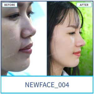 Hình ảnh nâng mũi trước sau Bs Trần Phương - Ca 4