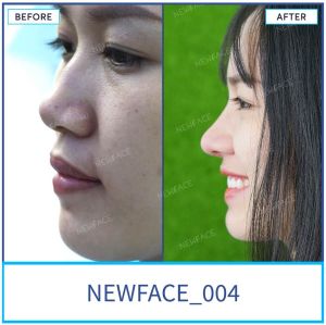 Hình ảnh nâng mũi trước sau Bs Trần Phương - Ca 4