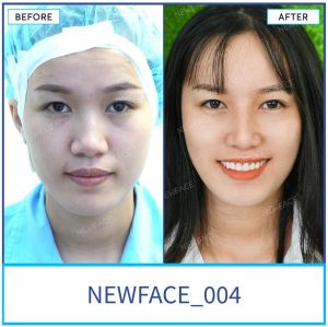 Hình ảnh nâng mũi trước sau Bs Trần Phương - Ca 4