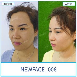 Hình ảnh nâng mũi trước sau Bs Trần Phương - Ca 6