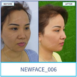Hình ảnh nâng mũi trước sau Bs Trần Phương - Ca 6