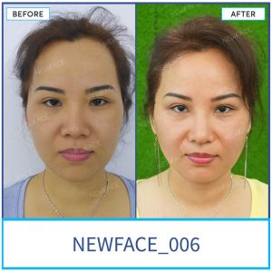 Hình ảnh nâng mũi trước sau Bs Trần Phương - Ca 6