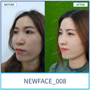 Hình ảnh nâng mũi trước sau Bs Trần Phương - Ca 8