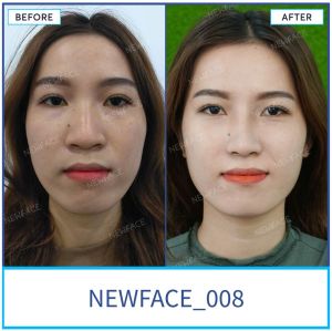 Hình ảnh nâng mũi trước sau Bs Trần Phương - Ca 8