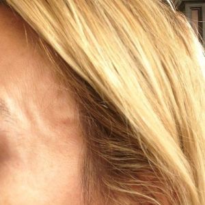 Làm sao để loại bỏ động mạch nổi lên ở thái dương?