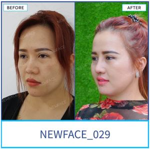 Hình ảnh nâng mũi trước sau Bs Trần Phương - Ca 29
