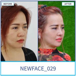 Hình ảnh nâng mũi trước sau Bs Trần Phương - Ca 29