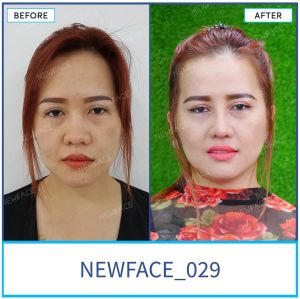 Hình ảnh nâng mũi trước sau Bs Trần Phương - Ca 29