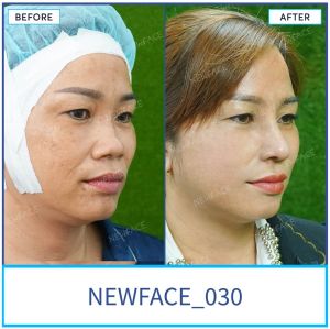 Hình ảnh nâng mũi trước sau Bs Trần Phương - Ca 30