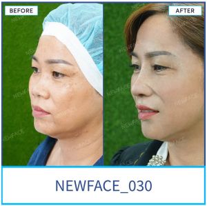 Hình ảnh nâng mũi trước sau Bs Trần Phương - Ca 30