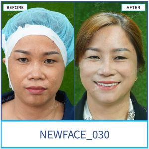 Hình ảnh nâng mũi trước sau Bs Trần Phương - Ca 30