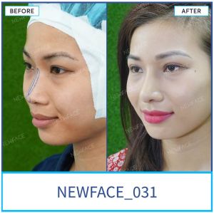 Hình ảnh nâng mũi trước sau Bs Trần Phương - Ca 31