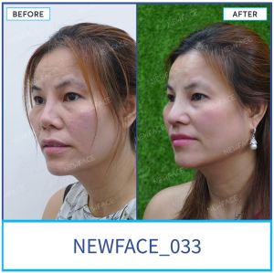 Hình ảnh nâng mũi trước sau Bs Trần Phương - Ca 33