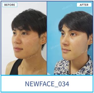 Hình ảnh nâng mũi trước sau Bs Trần Phương - Ca 34