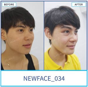 Hình ảnh nâng mũi trước sau Bs Trần Phương - Ca 34