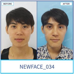 Hình ảnh nâng mũi trước sau Bs Trần Phương - Ca 34