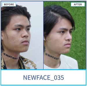 Hình ảnh nâng mũi trước sau Bs Trần Phương - Ca 35