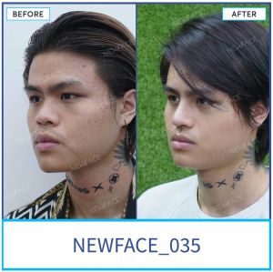 Hình ảnh nâng mũi trước sau Bs Trần Phương - Ca 35