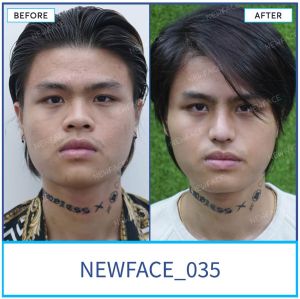 Hình ảnh nâng mũi trước sau Bs Trần Phương - Ca 35