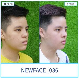 Hình ảnh nâng mũi trước sau Bs Trần Phương - Ca 36