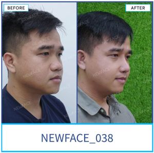 Hình ảnh nâng mũi trước sau Bs Trần Phương - Ca 38