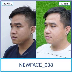 Hình ảnh nâng mũi trước sau Bs Trần Phương - Ca 38