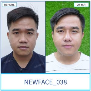 Hình ảnh nâng mũi trước sau Bs Trần Phương - Ca 38