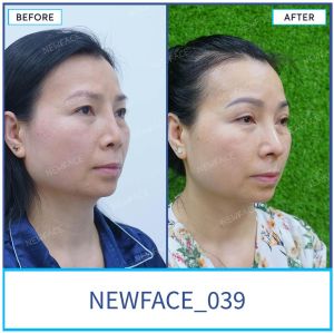 Hình ảnh nâng mũi trước sau Bs Trần Phương - Ca 39