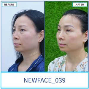 Hình ảnh nâng mũi trước sau Bs Trần Phương - Ca 39