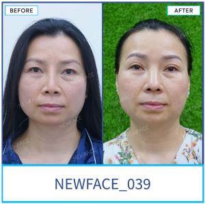 Hình ảnh nâng mũi trước sau Bs Trần Phương - Ca 39