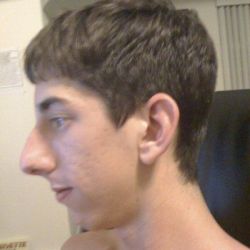 Nên phẫu thuật độn cằm hay trượt cằm?