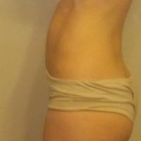 Laser hủy mỡ SculpSure có phù hợp với tôi không?