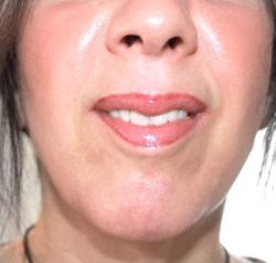 Ultherapy có phù hợp với tôi không?