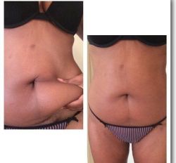 Bụng vẫn còn mỡ thừa sau khi hút mỡ