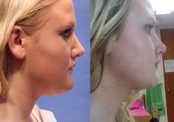 Có thể tiêm mỡ tự thân vào cổ để trở lại như trước khi hút mỡ không?