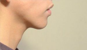 Tôi nên chọn filler nào để tăng độ nhô cho cằm và cần tiêm mấy ống?