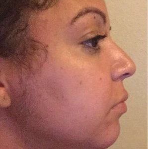 Tiêm filler có thể trị nọng cằm không?